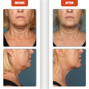 Terese Taylor M.D. - Cape Coral and Pompano Beach Doctor - Kybella Before and After