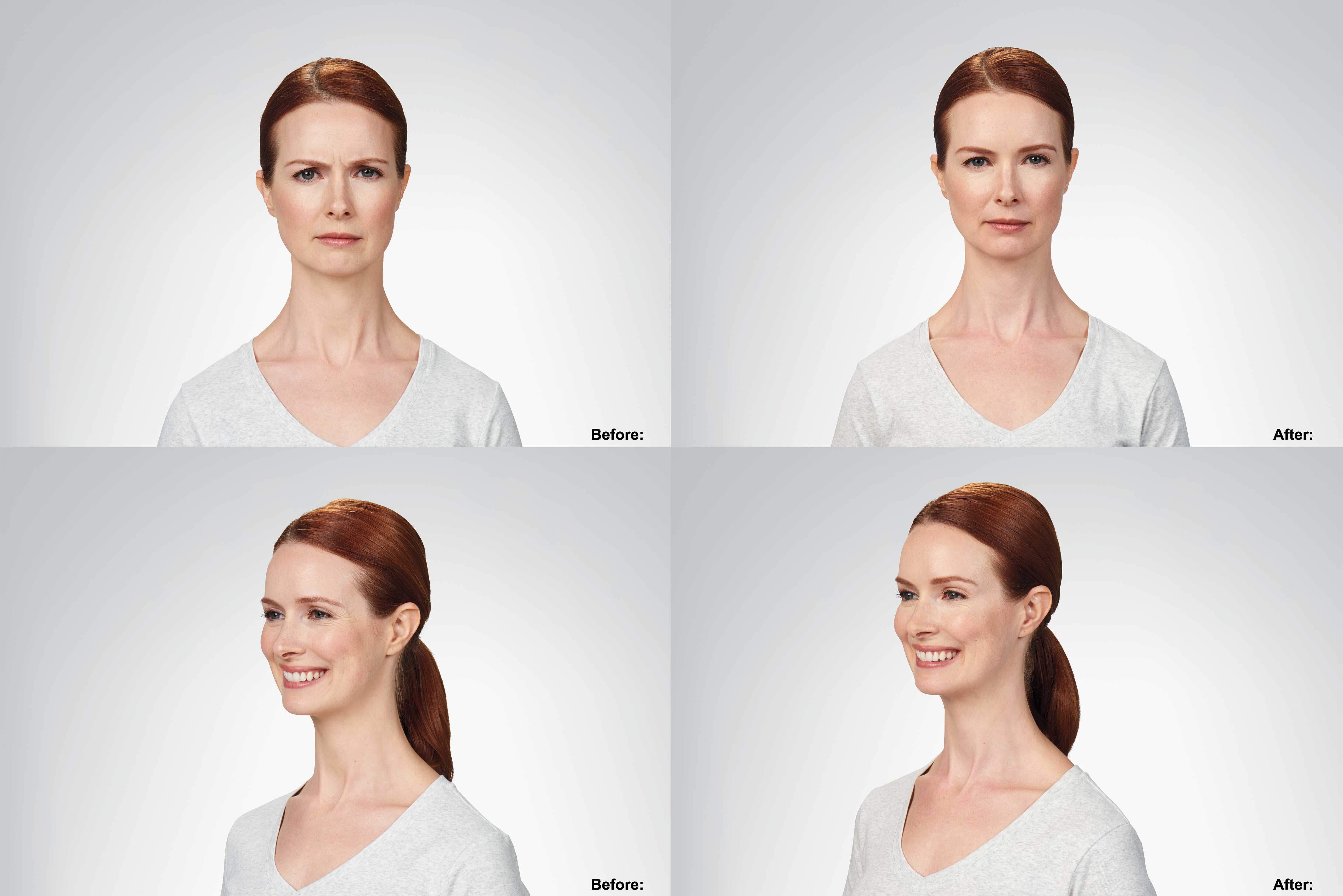 Botox Doctor in Cape Coral - Dr. Terese Taylor M.D. - Before and After